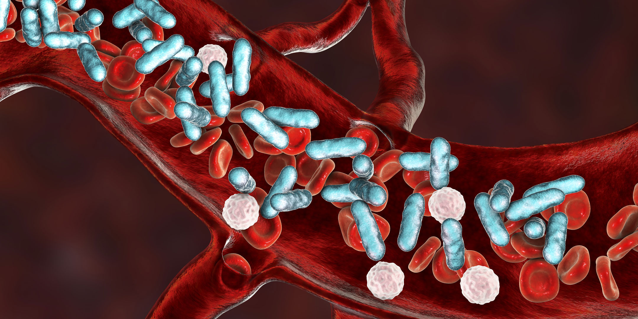 Risk Tips for Early Detection and Management of Sepsis